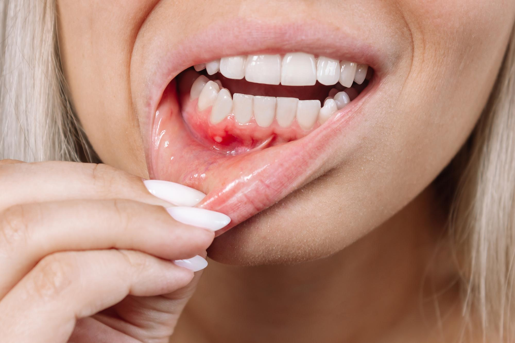 Periodontitt behandling hos Strømmen Tannhelse – behandling av tannkjøttsykdom